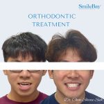 Blog header featuring a teen patient’s confident smile after orthodontic treatment and a close-up of braces, representing successful bite correction at SmileBay.
