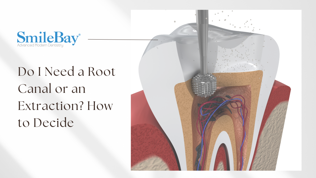 Cross-section of a tooth undergoing root canal treatment showing dental pulp and nerve removal