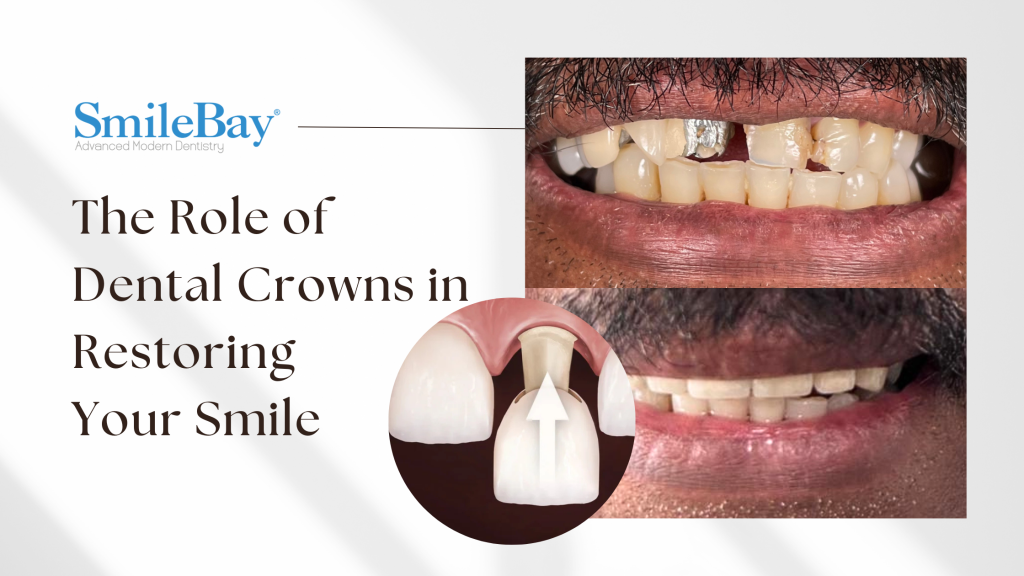 Before and after dental crowns treatment at SmileBay Dental Penang