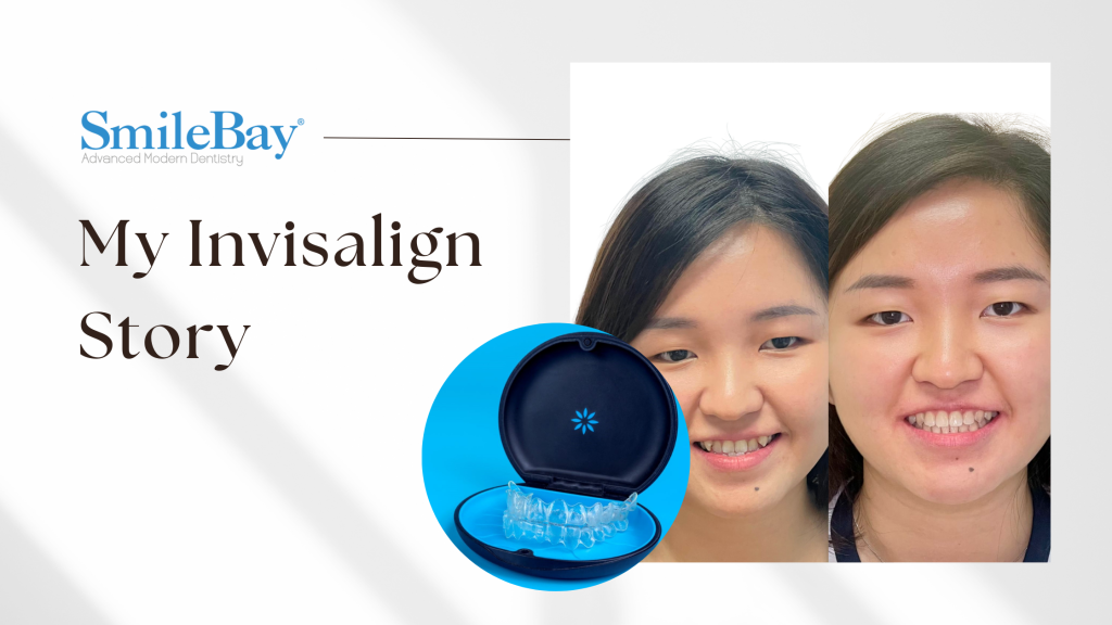 SmileBay patient before and after Invisalign treatment in Penang